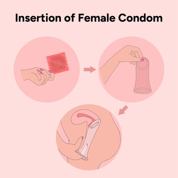 Insertion of female condom, gynecology illustration