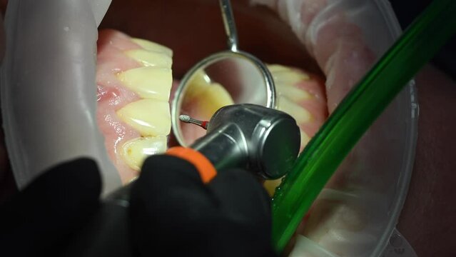 Dental Extreme Close up Macro Video. Dentist treat patient teeth. Dental internist works with an assistant use cofferdam. Concept of professional dental hygiene. 4k 120 fps slow motion raw footage