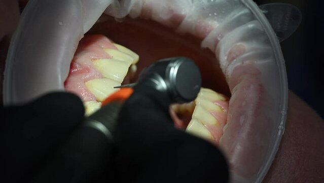 Dental Extreme Close up Macro Video. Dentist treat patient teeth. Dental internist works with an assistant use cofferdam. Concept of professional dental hygiene. 4k 120 fps slow motion raw footage