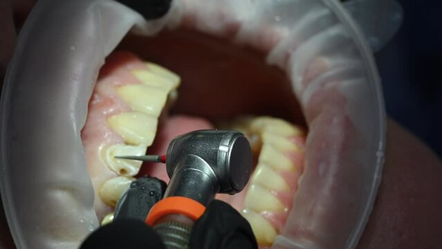 Dental Extreme Close up Macro Video. Dentist treat patient teeth. Dental internist works with an assistant use cofferdam. Concept of professional dental hygiene. 4k 120 fps slow motion raw footage