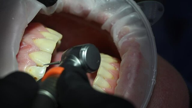 Dental Extreme Close up Macro Video. Dentist treat patient teeth. Dental internist works with an assistant use cofferdam. Concept of professional dental hygiene. 4k 120 fps slow motion raw footage