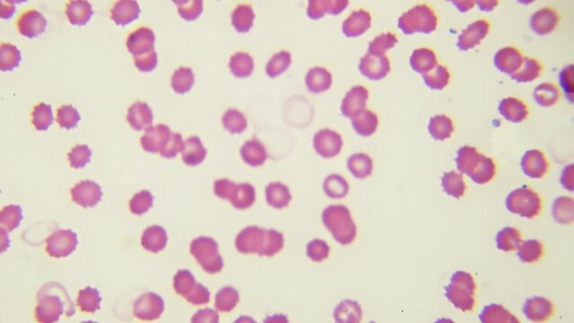 RBC and WBC under microscope. HQ video. Science class. Inspection of human blood components on a fixed and stained sample. Biochemical laboratory. High performance sport. 1000x times magnification