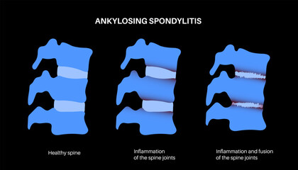 Ankylosing spondylitis disease