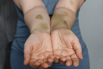 Female hand with car accident scar. Female hand with bruise - obrazy, fototapety, plakaty