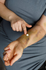 Applying aid medication ointment on injured arm. Close up image of using ointment to heal brusied...