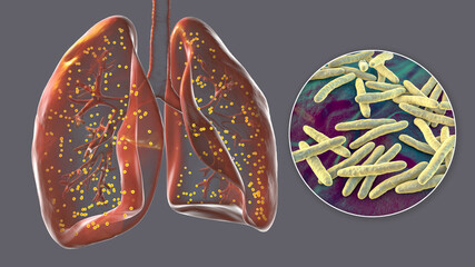 Human lungs affected by miliary tuberculosis, and close-up view of Mycobacterium tuberculosis, 3D illustration