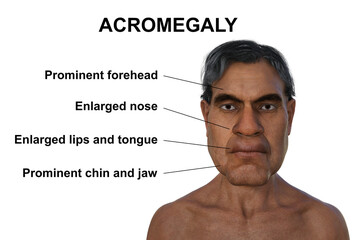 Obraz premium Acromegaly in a man, 3D illustration