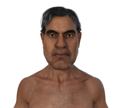Acromegaly in a man, 3D illustration