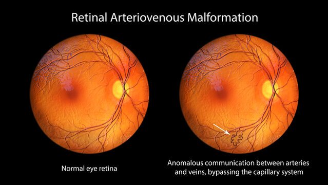 Retinal arteriovenous malformation, 3D illustration