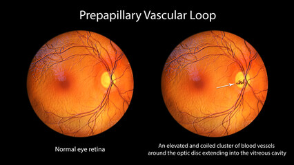 A prepapillary vascular loop on the retina, 3D illustration - obrazy, fototapety, plakaty