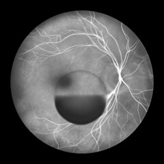 A subhyaloid hemorrhage on the retina as observed during ophthalmoscopy, an illustration