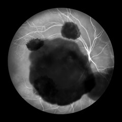 A subretinal hemorrhage as observed during ophthalmoscopy, an illustration