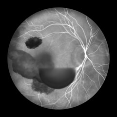 A medical illustration of Terson syndrome, revealing intraocular hemorrhage observed during ophthalmoscopy