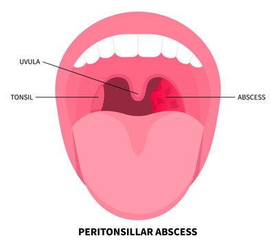 Throat abscess swelling of tonsil gland that cause by bacterial infection with medical examination