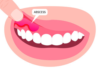 Gum swollen and bad breath with teeth cavities broken wisdom cracked pain oral hygiene health