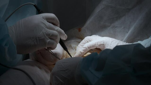 Cardiac surgeon and team perform median sternotomy. Action. Surgeon cauterizing and using professional tool.