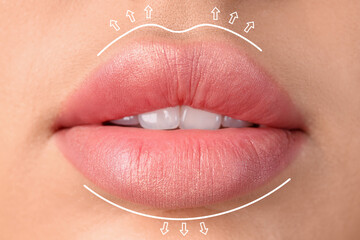 Lips of beautiful young woman with marking for filler injection, closeup