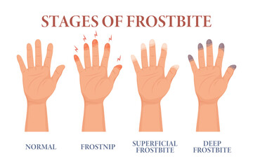 Frostbite stages. Frozen hands in different stages. Medical frostbite. Skin burn symptom. Health care medical concept. Vector