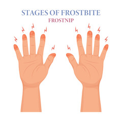 Frostbite stages. Frozen hands in different stages. Medical frostbite. Skin burn symptom. Health care medical concept. Vector