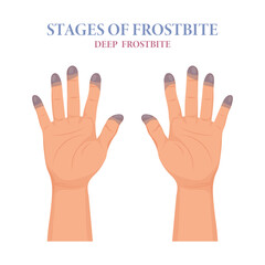 Fototapeta premium Frostbite stages. Frozen hands in different stages. Medical frostbite. Skin burn symptom. Health care medical concept. Vector