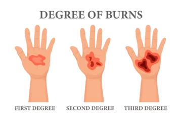 Foto op Canvas Burn stages. Burnt hands at various degrees. Skin burn symptoms. Medical healthcare concept. Vector © Tatiana