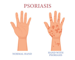 Psoriasis, healthy and unhealthy hand. Dermatology. The concept of medicine and healthcare. Poster, banner, vector