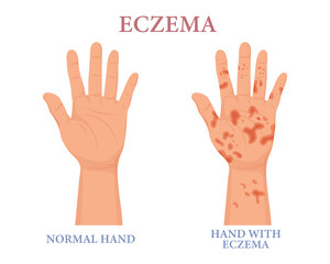 Fototapeta premium Eczema, healthy and unhealthy hand. Dermatology. The concept of medicine and healthcare. Poster, banner, vector