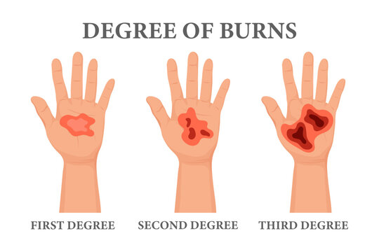 Burn stages. Burnt hands at various degrees. Skin burn symptoms. Medical healthcare concept. Vector