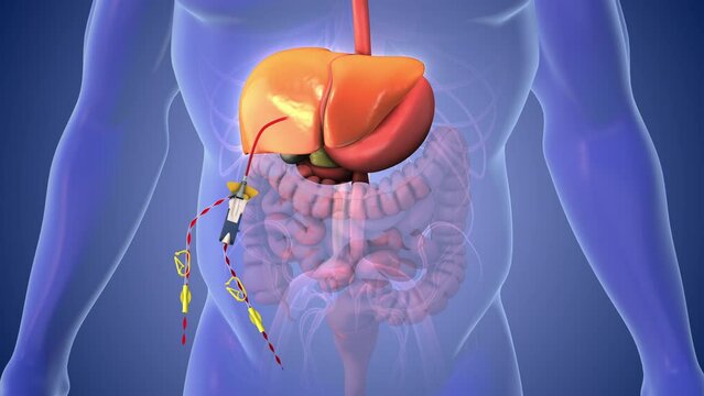 Chemotherapy for liver cancer medical concept