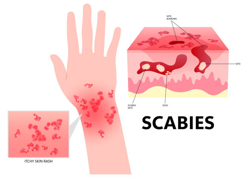 Scabies mites cause hand skin red itching and inflammation