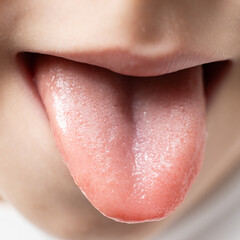 The tongue of a six-year-old healthy child, papillae on the tongue © Zarina Lukash