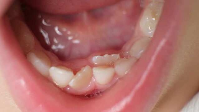Crookedly growing teeth to replace milk teeth in a child. The second row of teeth, the tooth grows while the incisor has not yet fallen out.