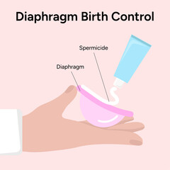 Diaphragm birth control, diaphragmwith spermicide  - obrazy, fototapety, plakaty