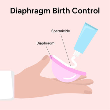 Diaphragm Birth Control Images – Browse 1,587 Stock Photos, Vectors ...