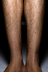 Vasculitis. Vasculitis in legs. Small red or purple spots. Post covid syndrome due to an...