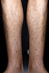 Vasculitis. Vasculitis in legs. Small red or purple spots. Post covid syndrome due to an immunological reaction of the body. Grain. Inflammation of the blood vessels. Rare disease. Photography.