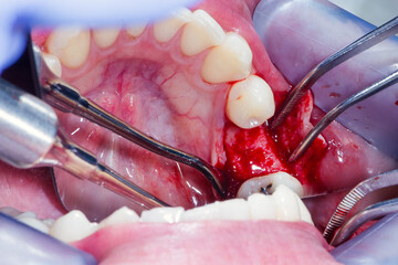 Opened mandibular bone after surgical incision of the gums with a scalpel before dental implantation