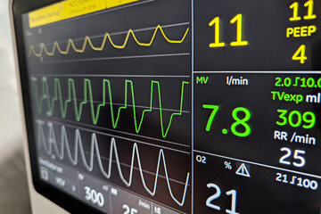 Anesthesia ventilator monitor screen showing waveforms of patient ventilation