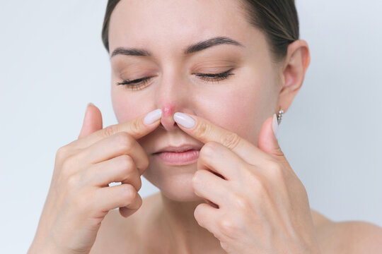 a close-up photo of the face of a young dark-haired woman squeezing out a red pimple on her nose. Dermatology, acne, problem skin.