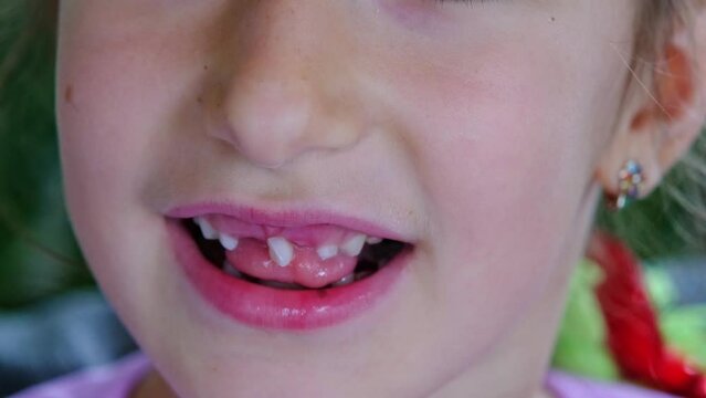 The child shakes the front baby tooth and smiles a toothless smile close-up. Changing teeth to molars in childhood