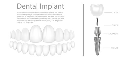 Dental implant structure medical pictorial educative infographic poster with molar replacement end healthy tools models vector illustration.