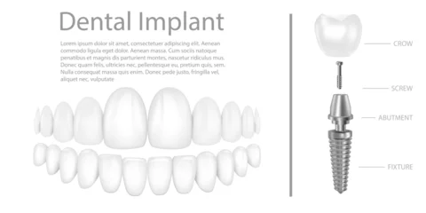 Poster Dental implant structure medical pictorial educative infographic poster with molar replacement end healthy tools models vector illustration. © Siarhei