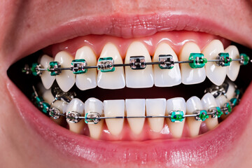 metal green braces on white teeth. AI GENERATE