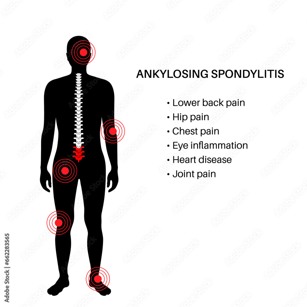 Canvas Prints Ankylosing spondylitis disease