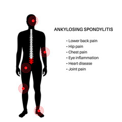 Ankylosing spondylitis disease