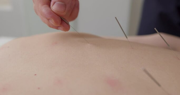 close up video of man's hands taking needle out of the female's skin Slow motion, stimulating energy channels and promoting healing. Chinese Medicine technique