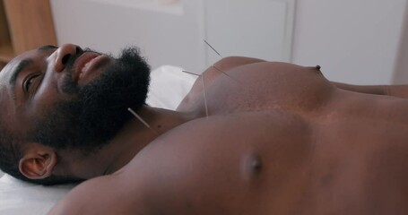 happy young man getting needles treatment at clinic slow motion. painless and effective procedure. Without Fear, African American patient is trying acupuncture