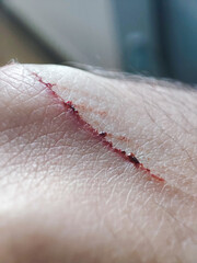  Close-up image of a bleeding wound on human skin.