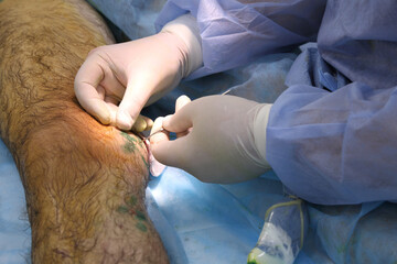 Medical surgery for endovenous laser photocoagulation of the great saphenous vein. Miniphlegectomy....