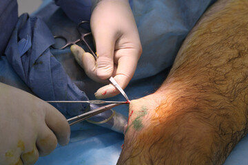 Medical surgery for endovenous laser photocoagulation of the great saphenous vein. Miniphlegectomy....